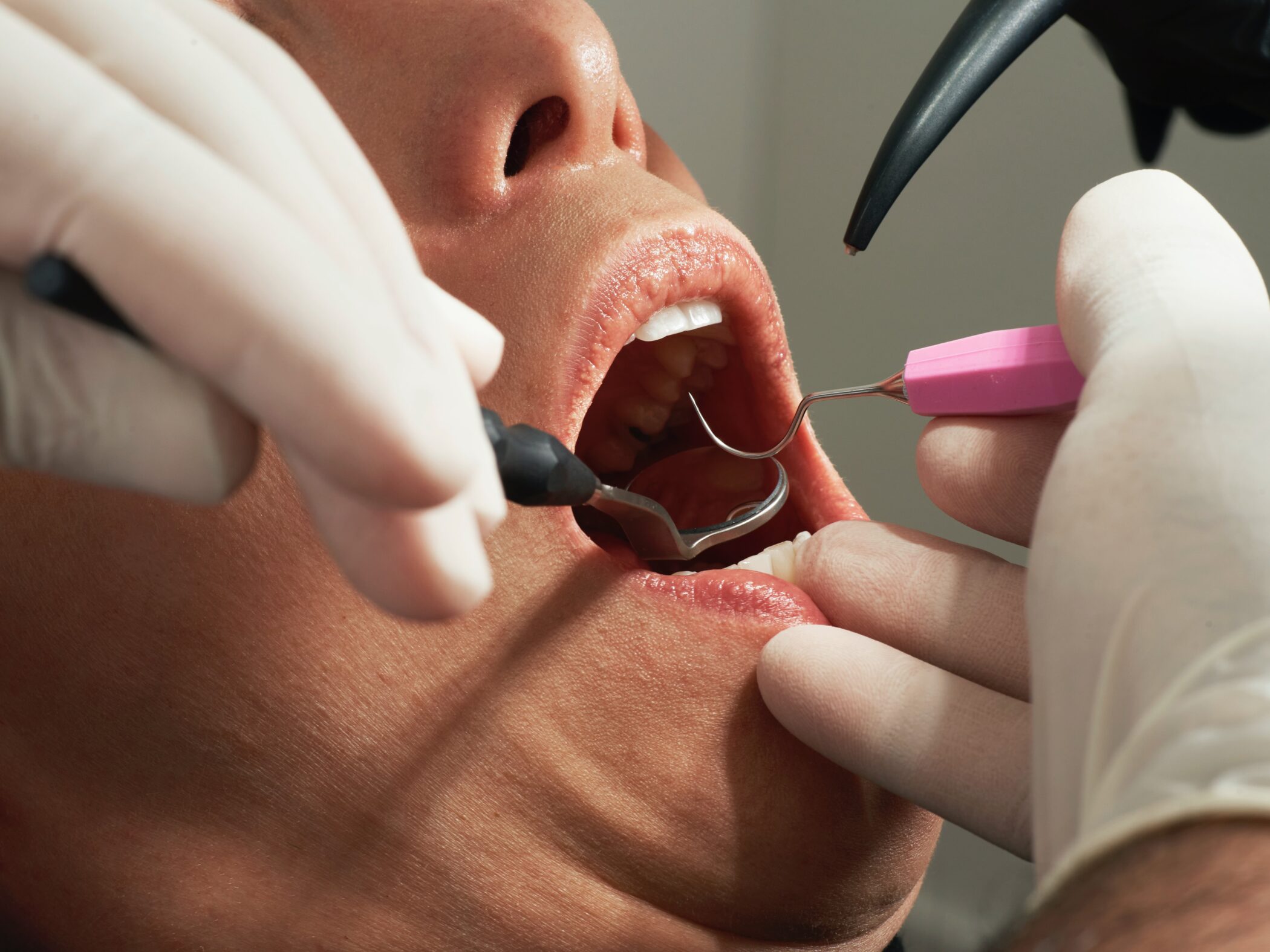 The Most Common Treatments For Broken And Missing Teeth