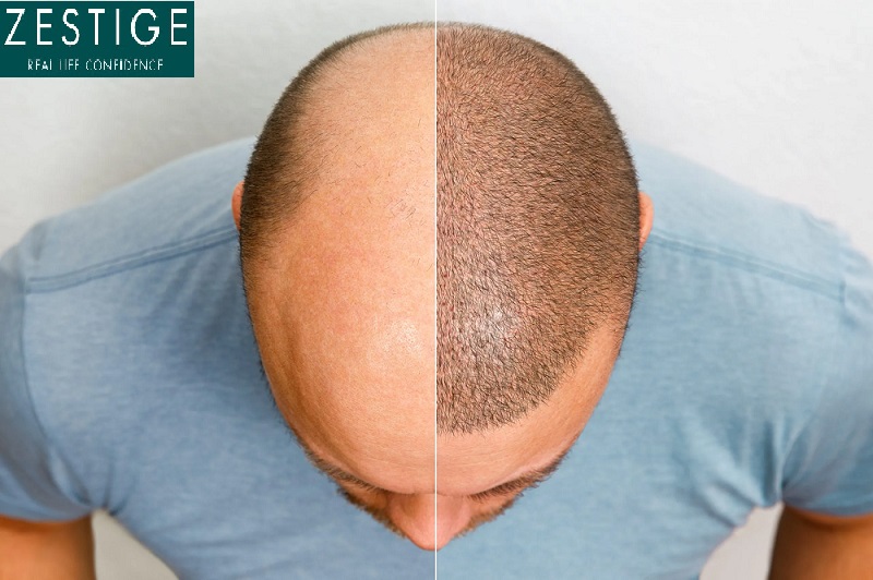 The Truth Behind Hair Transplant Cost 