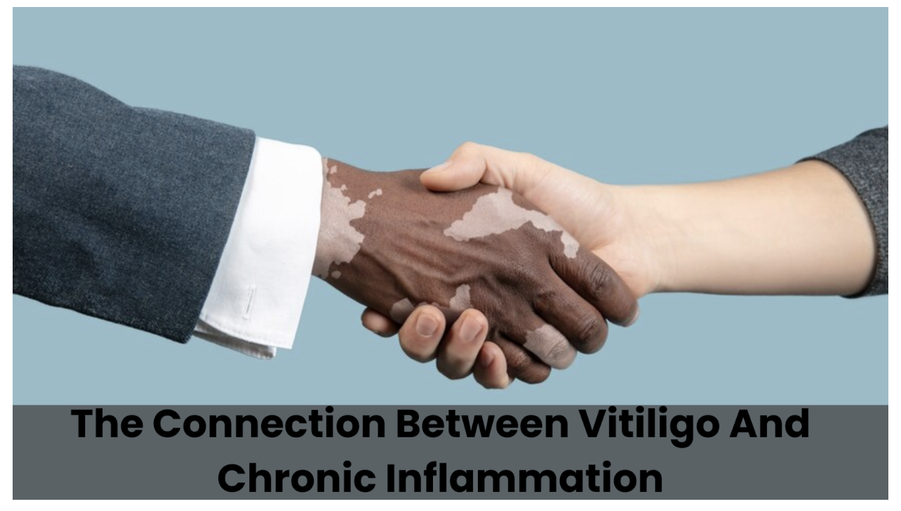 How Chronic Inflammation Is Related to Vitiligo?: Is It Even Related At All?